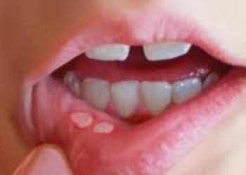 NGUYÊN NHÂN, TRIỆU CHỨNG VÀ CÁCH CHỮA LỠ MIỆNG KHÔNG GÂY ĐAU NHỨT