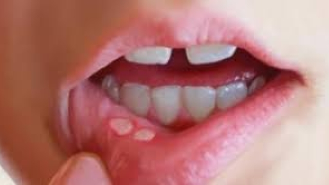NGUYÊN NHÂN, TRIỆU CHỨNG VÀ CÁCH CHỮA LỠ MIỆNG KHÔNG GÂY ĐAU NHỨT 1 NGUYÊN NHÂN, TRIỆU CHỨNG VÀ CÁCH CHỮA LỠ MIỆNG KHÔNG GÂY ĐAU NHỨT