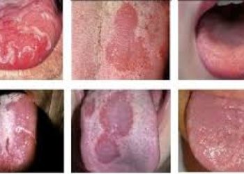 NHẬN BIẾT ĐƯỢC CÁC CHỨNG BỆNH THÔNG QUA LƯỠI. NHỮNG DẤU HIỆU CHÚNG TA KHÔNG NÊN XEM THƯỜNG