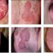 NHẬN BIẾT ĐƯỢC CÁC CHỨNG BỆNH THÔNG QUA LƯỠI. NHỮNG DẤU HIỆU CHÚNG TA KHÔNG NÊN XEM THƯỜNG 8 NHẬN BIẾT ĐƯỢC CÁC CHỨNG BỆNH THÔNG QUA LƯỠI. NHỮNG DẤU HIỆU CHÚNG TA KHÔNG NÊN XEM THƯỜNG
