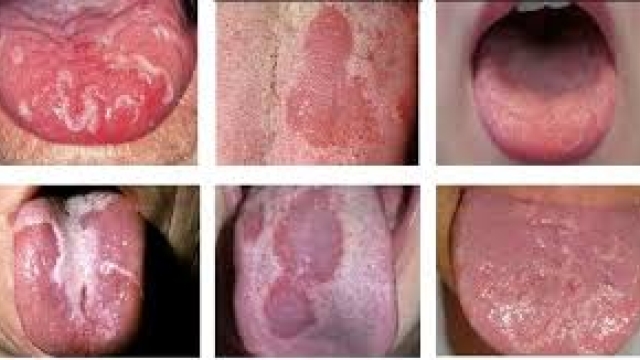 NHẬN BIẾT ĐƯỢC CÁC CHỨNG BỆNH THÔNG QUA LƯỠI. NHỮNG DẤU HIỆU CHÚNG TA KHÔNG NÊN XEM THƯỜNG 1 NHẬN BIẾT ĐƯỢC CÁC CHỨNG BỆNH THÔNG QUA LƯỠI. NHỮNG DẤU HIỆU CHÚNG TA KHÔNG NÊN XEM THƯỜNG